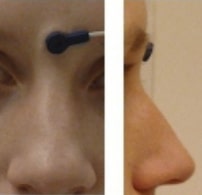 placement of NAS fiducial